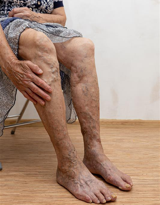 How Do You Know If You Have PAD? How Do You Know If You Have PAD?