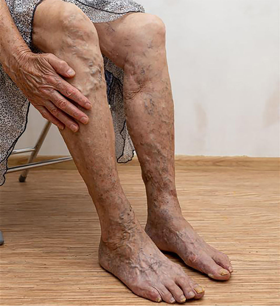 Your Legs Are Trying to Tell You Something: 7 Vascular Symptoms You Shouldn’t Ignore
